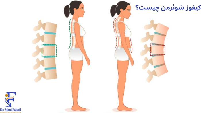 کیفوز شوئرمن