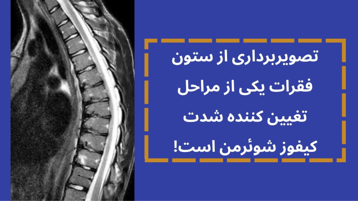 تشخیص کیفوز شوئرمن