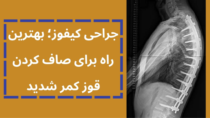 جراحی کیفوز شوئرمن