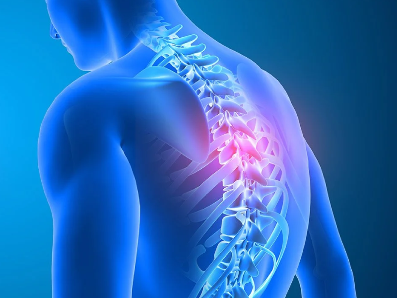 کیفوز شوئرمن