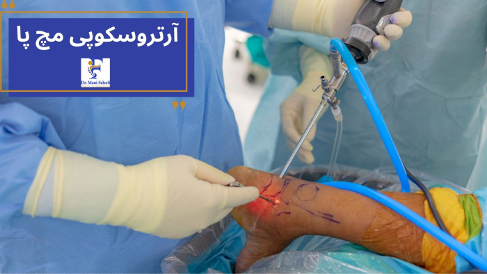 آرتروسکوپی مچ پا