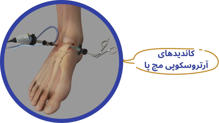 کاندیدای آرتروسکوپی مچ پا