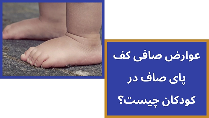 عوارض کف پای صاف در کودکان