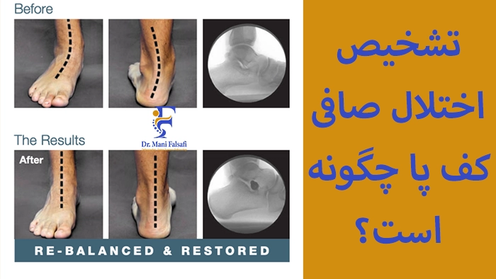 تشخیص کف پای صاف