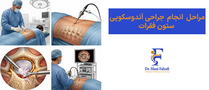 مراحل انجام جراحی آندوسکوپی ستون فقرات