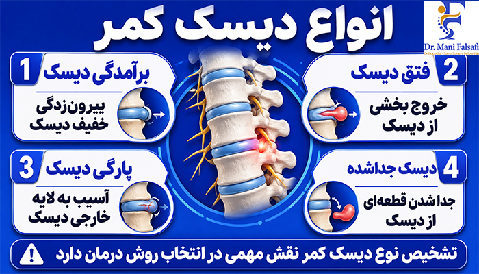 انواع دیسک کمر